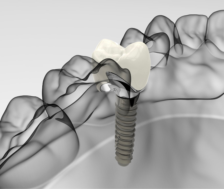 Implantologia | Studio Dentistico Pandolfi